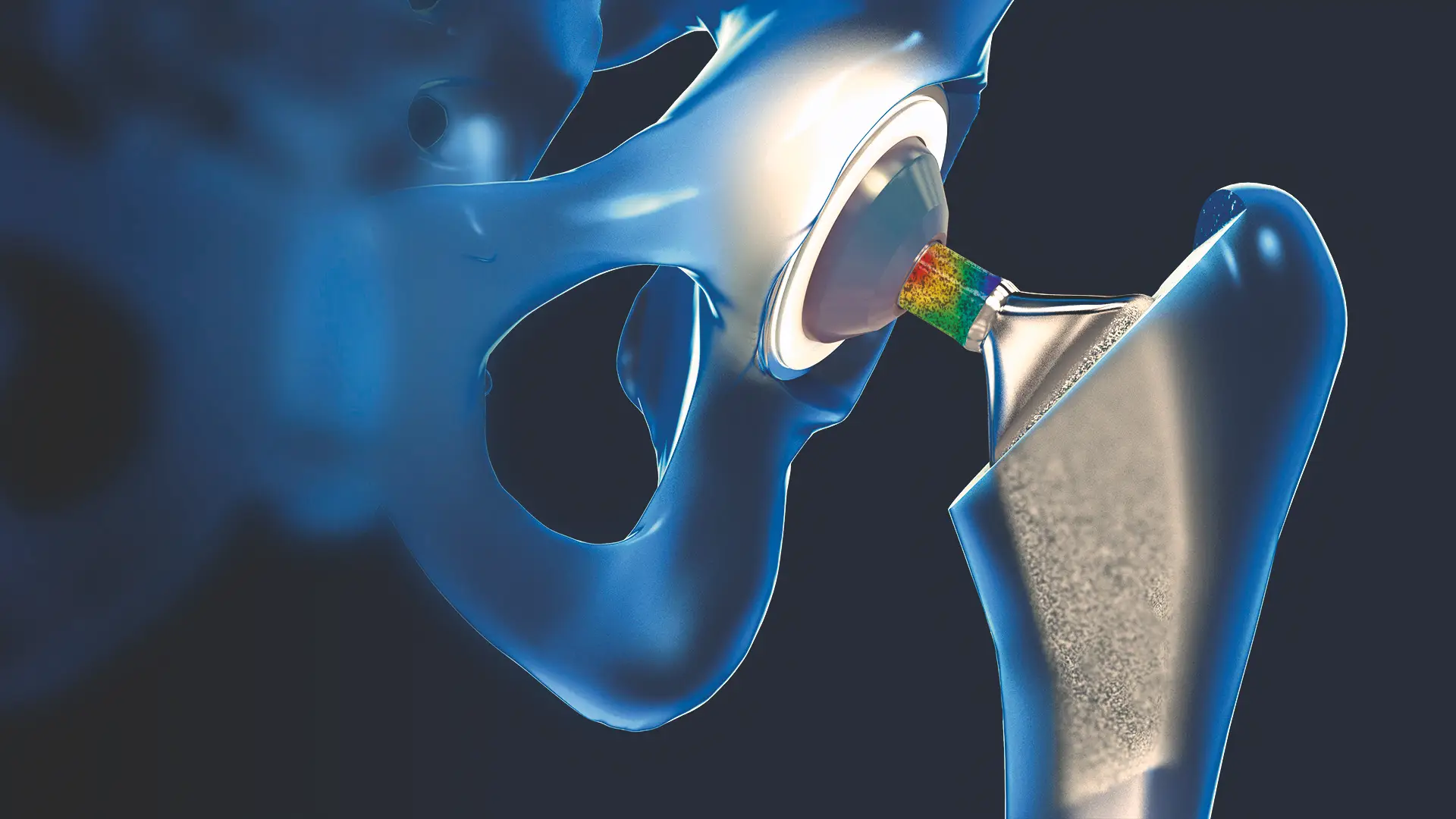 Rendering of a hip joint and implant, the bearing surface shown as a coloured measurement band